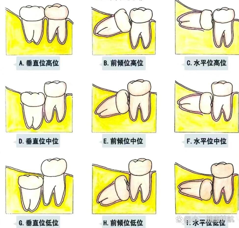 智齿盲袋冲洗步骤图图片