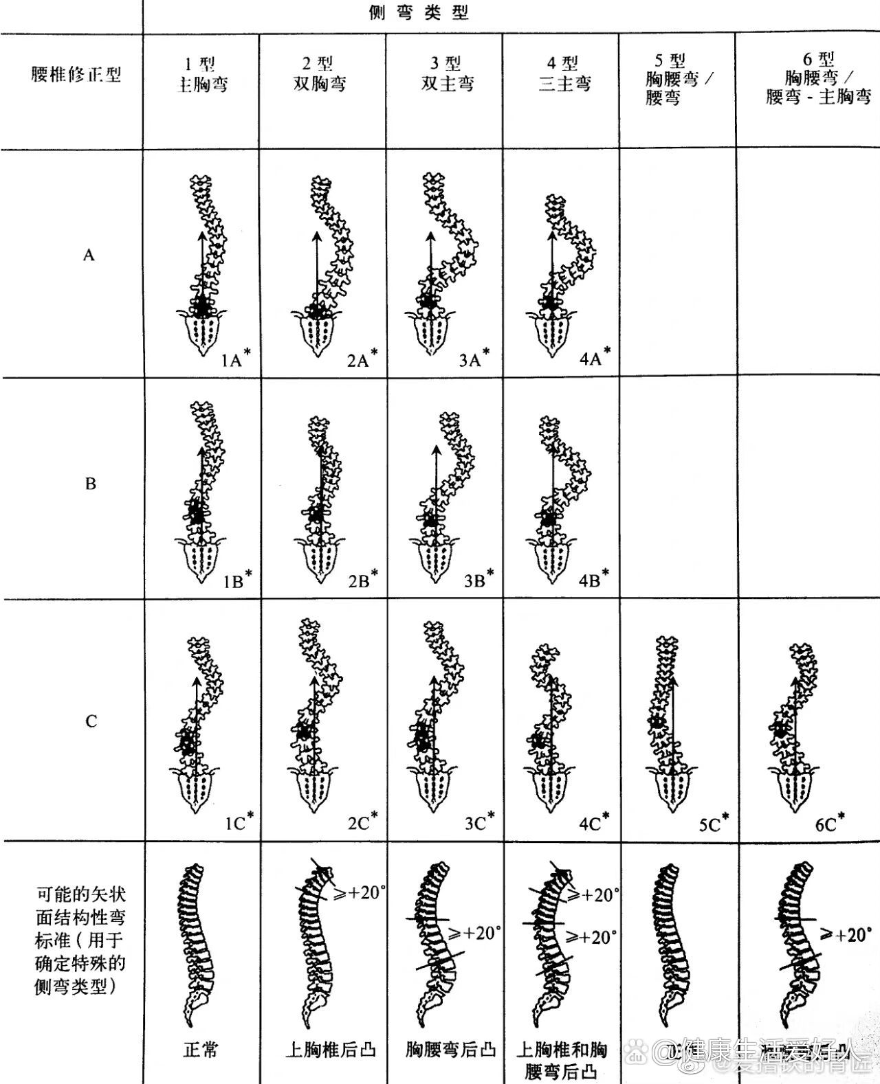 特发性脊柱侧弯常见分型