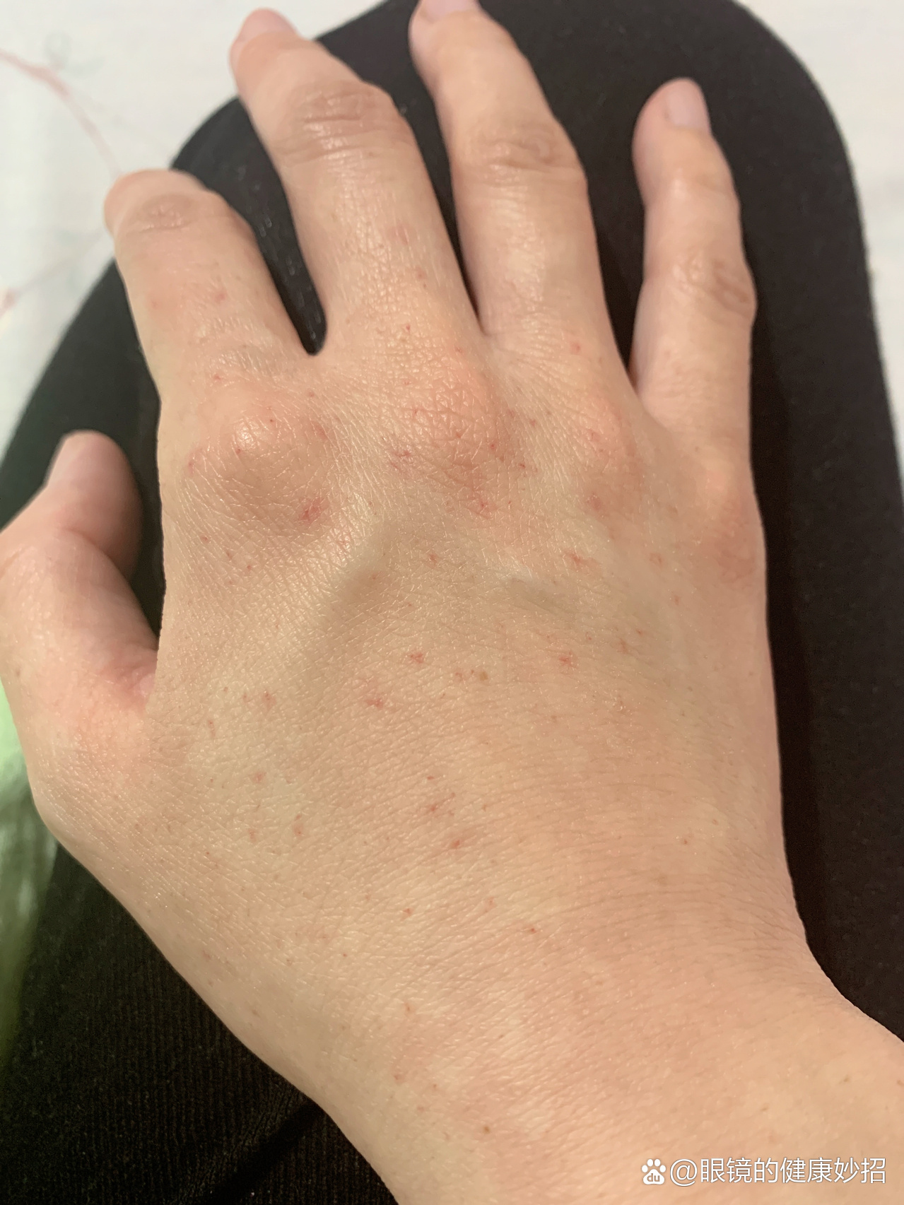 手上的小红点好多年了,不知道咋回事