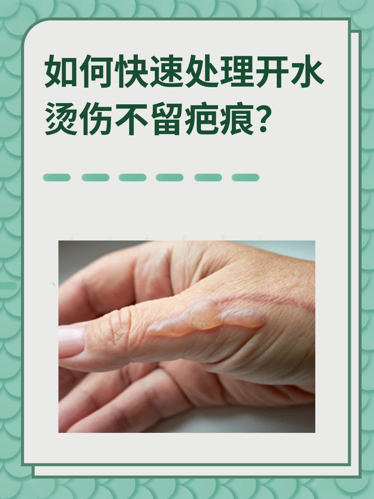 如何快速处理开水烫伤不留疤痕