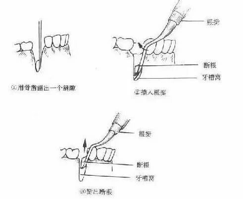 p 牙挺区分及用法