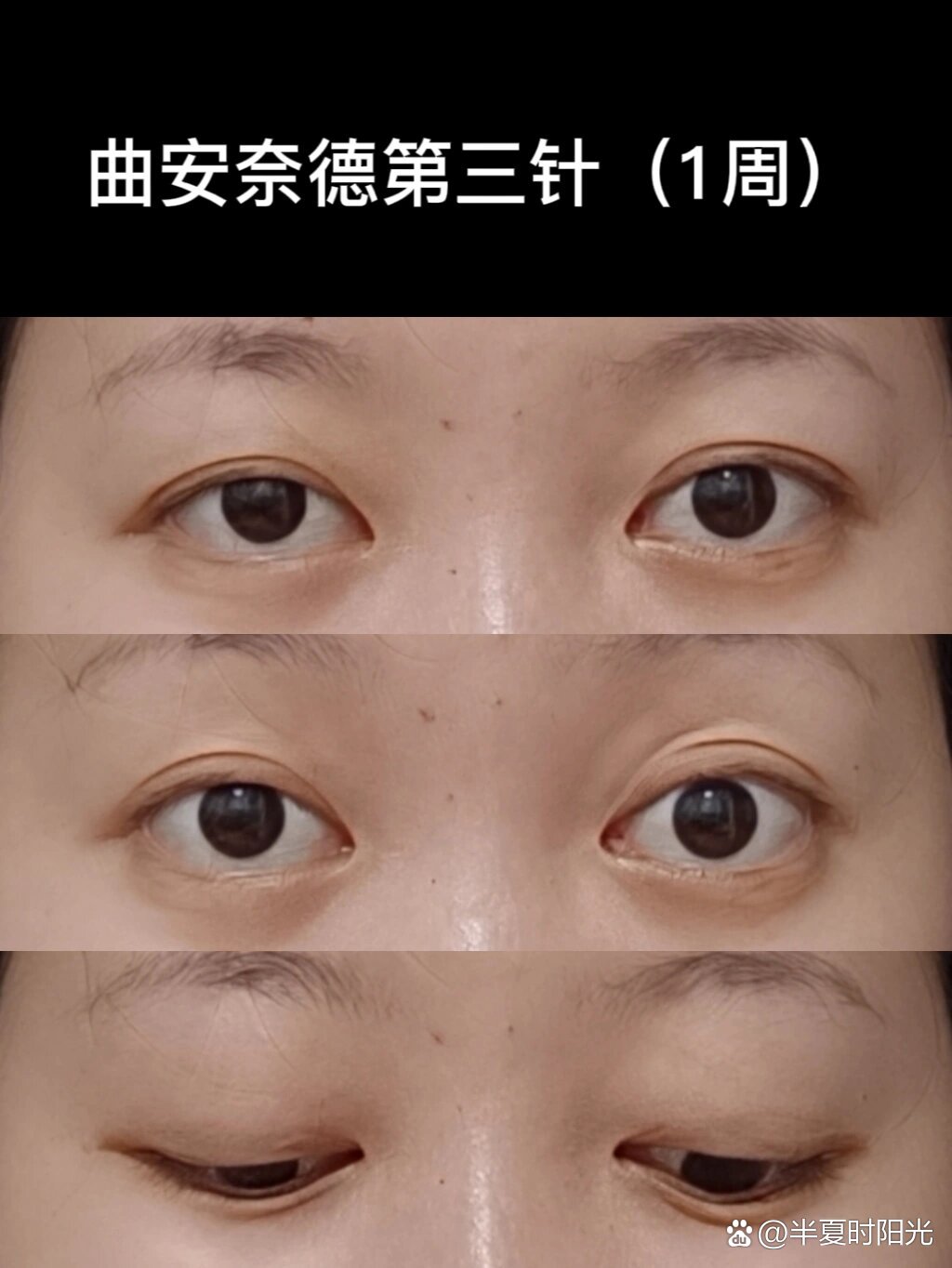 我的甲亢突眼治疗日记(七)