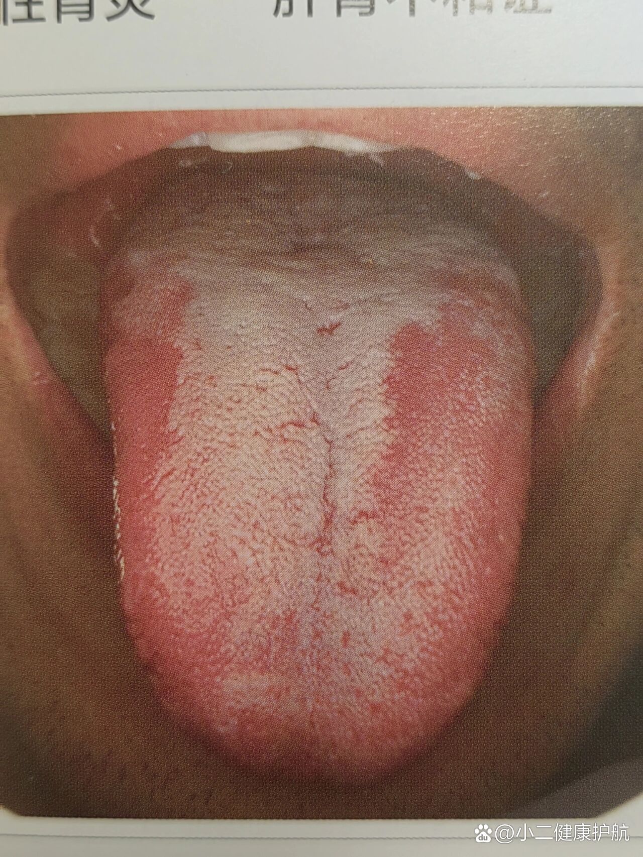 舌像案例四(舌暗红,剥苔厚腻)
