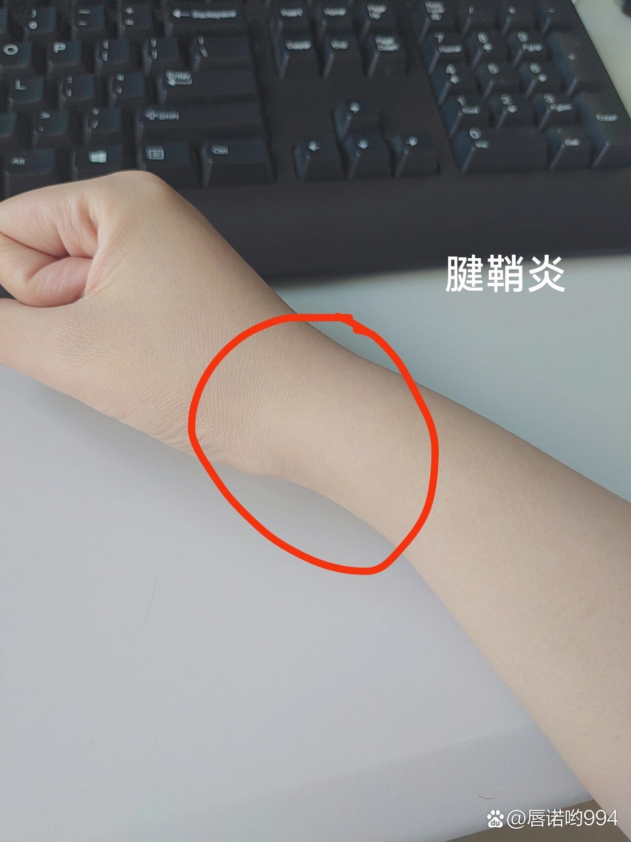 腱鞘炎特效穴分享