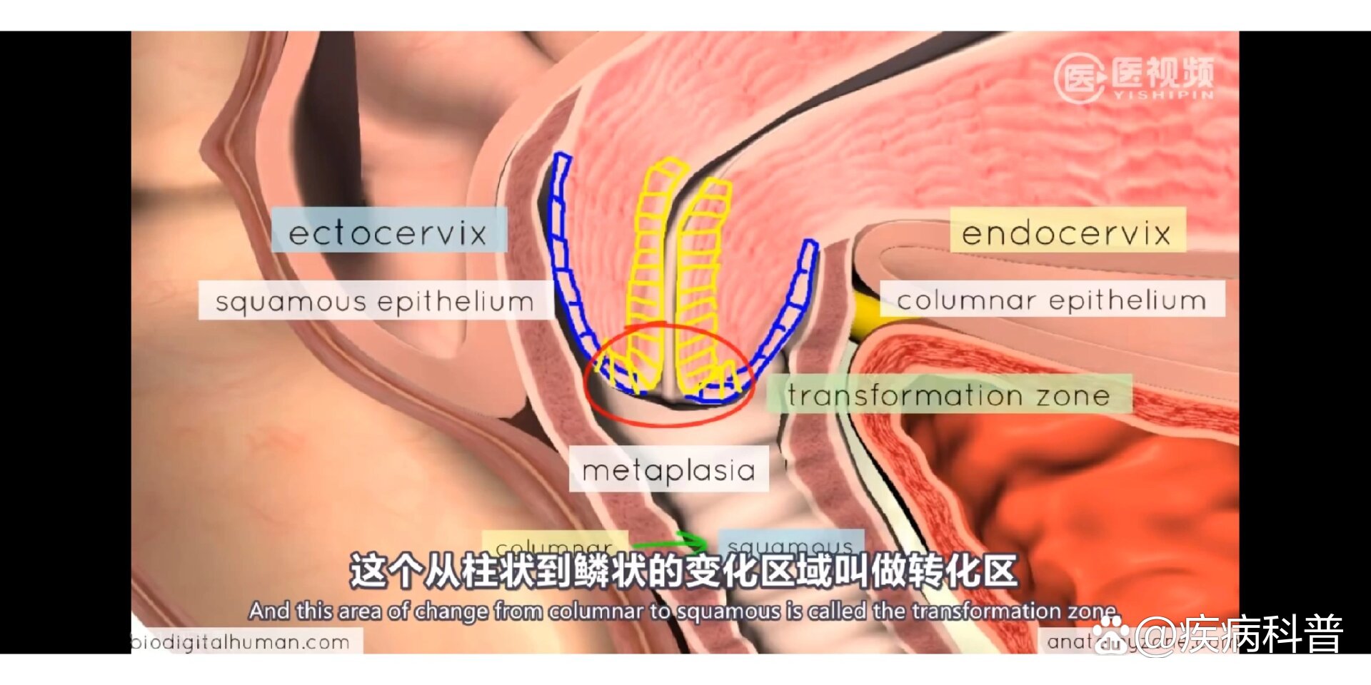 红色的是宫颈转化区,是鳞状上皮和柱状上皮的交界地带,是一个容易出血