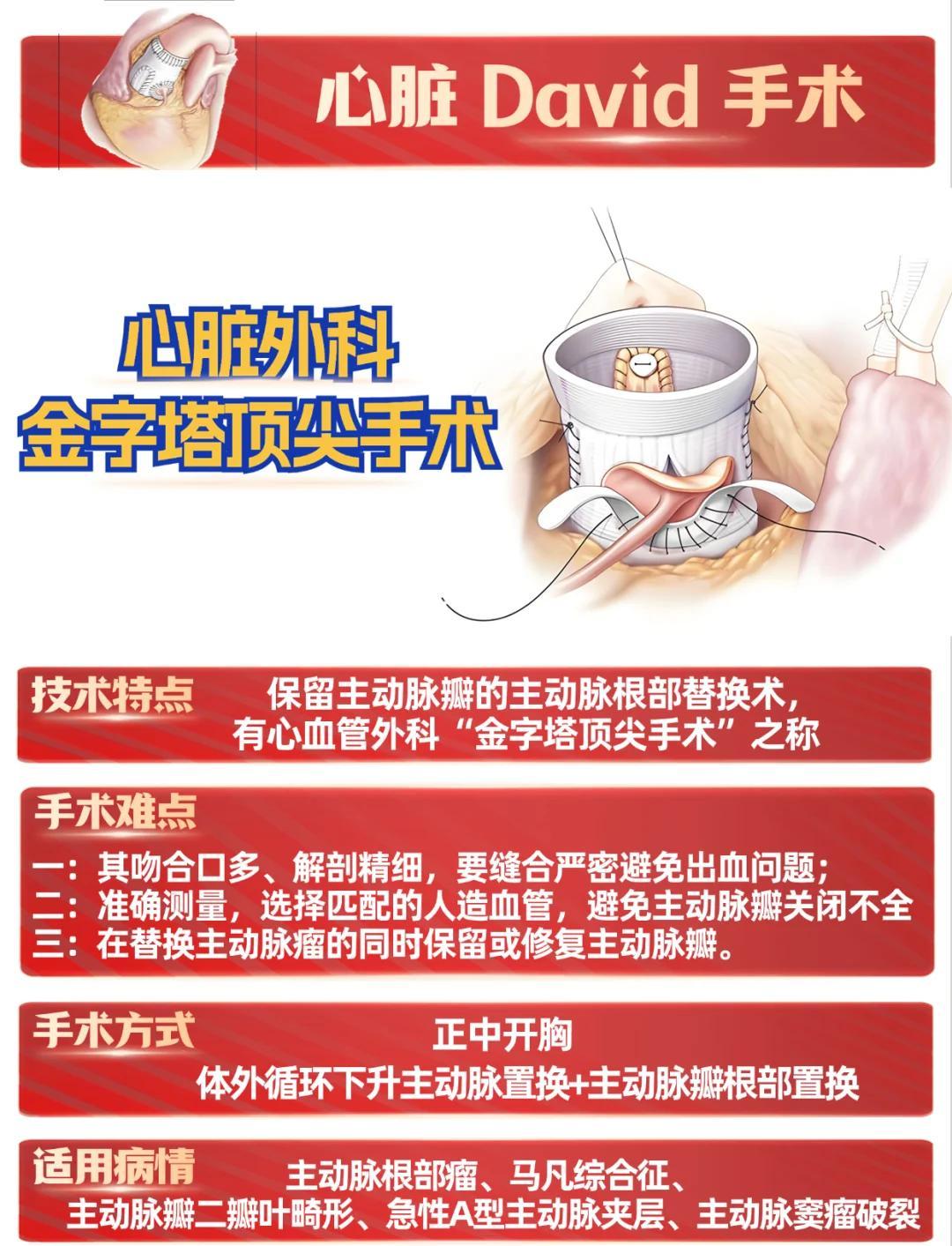 心脏外科巅峰手术：David手术全解析