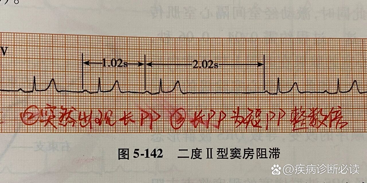 简易心电图(ii度ii型窦房传导阻滞)
