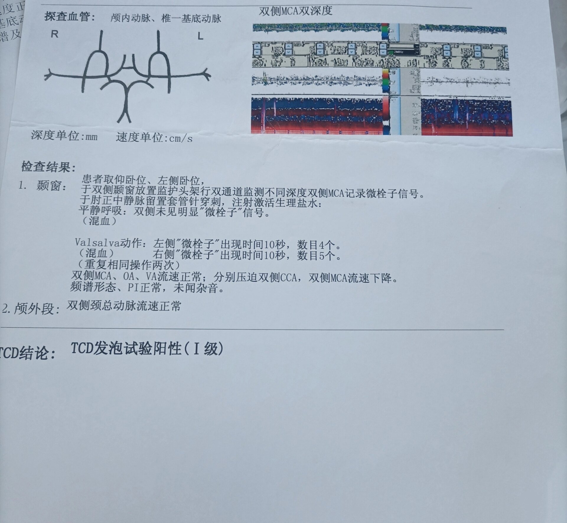 建议做卵圆孔手术,说结合本人有脑梗迹象(脱髓鞘,缺血灶)应该做卵圆孔