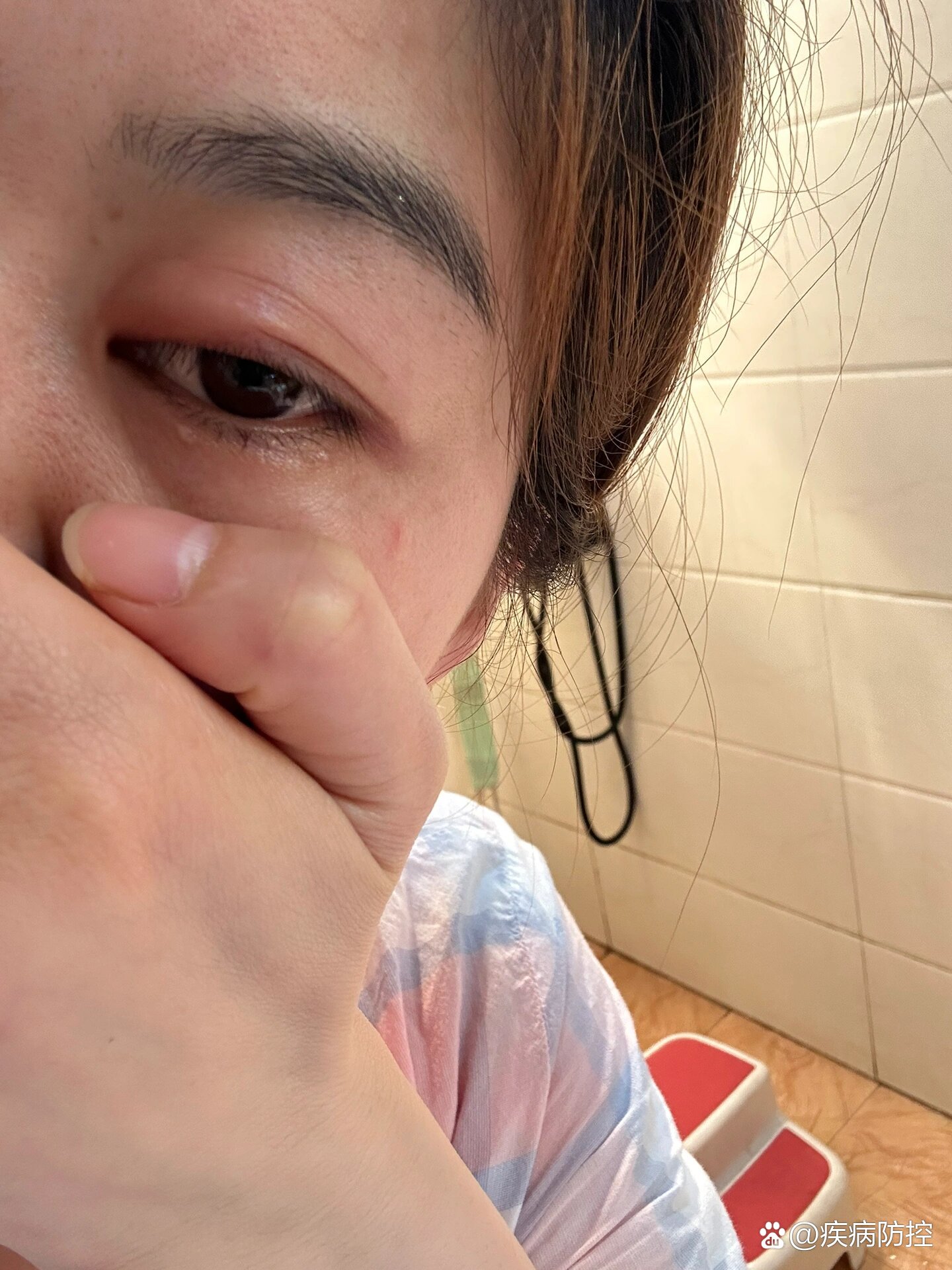 眼睛为什么突然肿了很疼怎么回事为什么在线 眼睛为什么突然肿了很疼怎么回事为什么在线