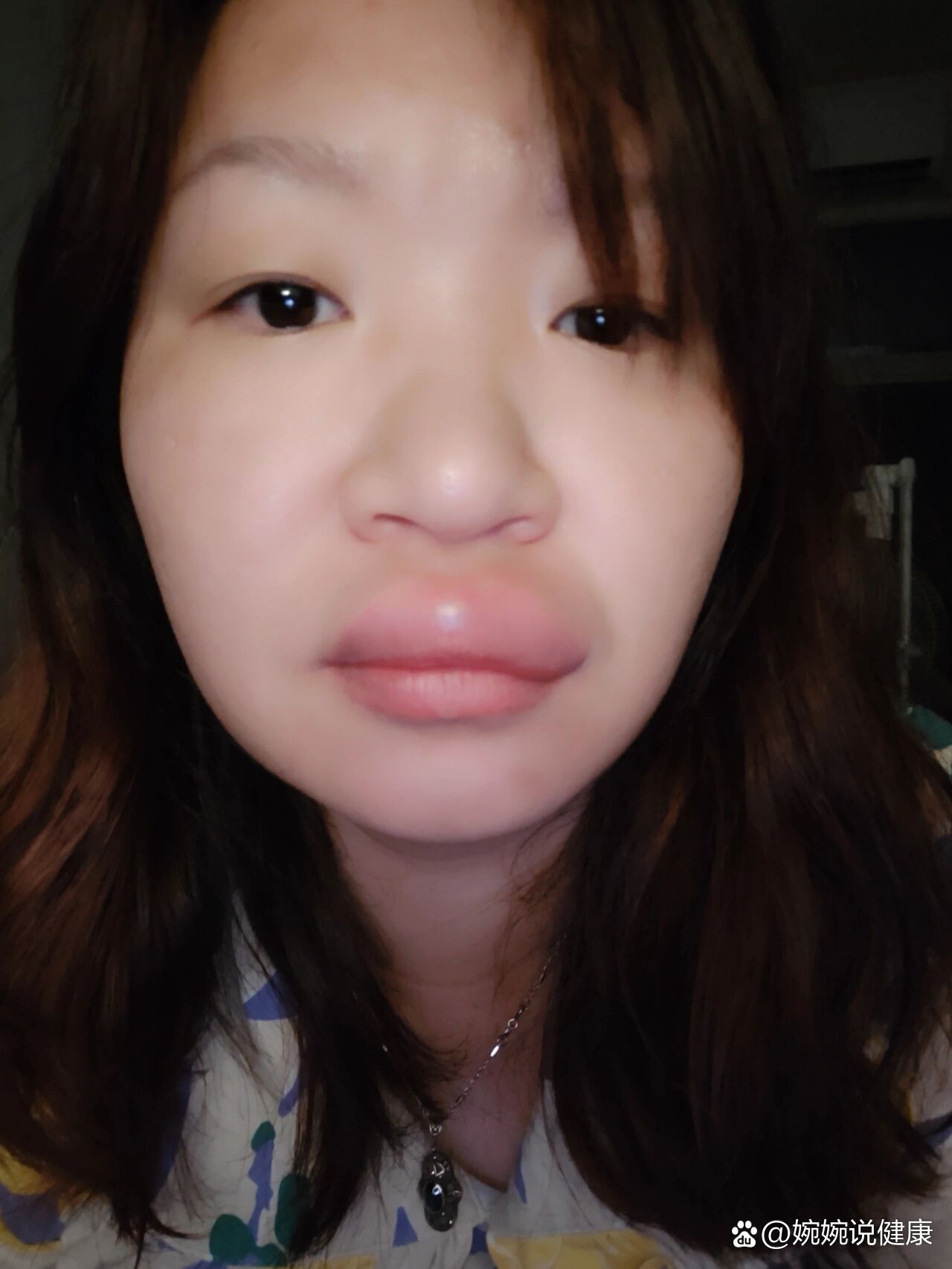 嘴巴突然肿了