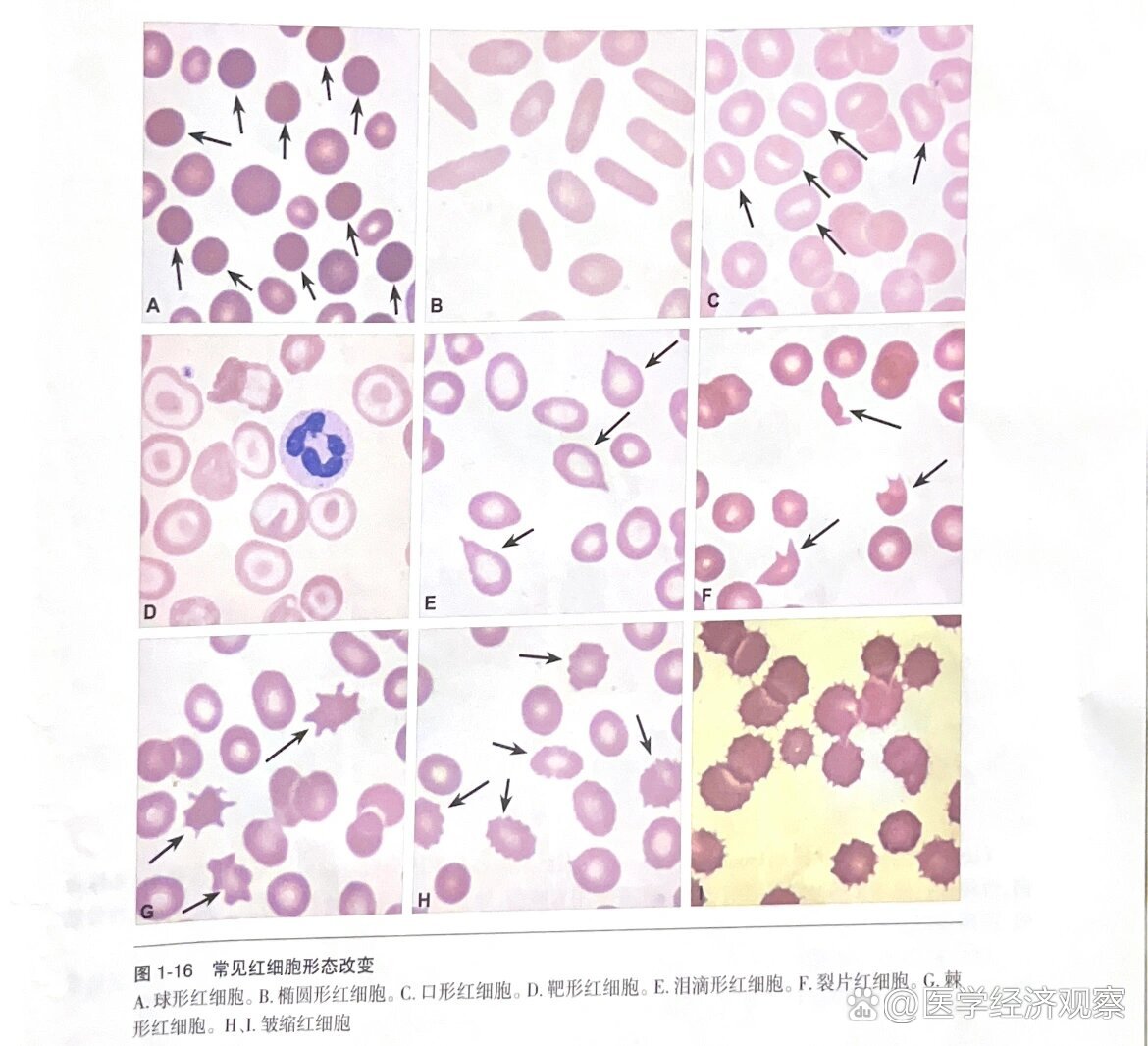 2张图片让你彻底学会成熟红细胞形态