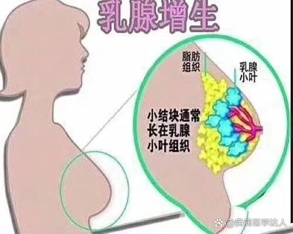 乳腺增生的危害图片