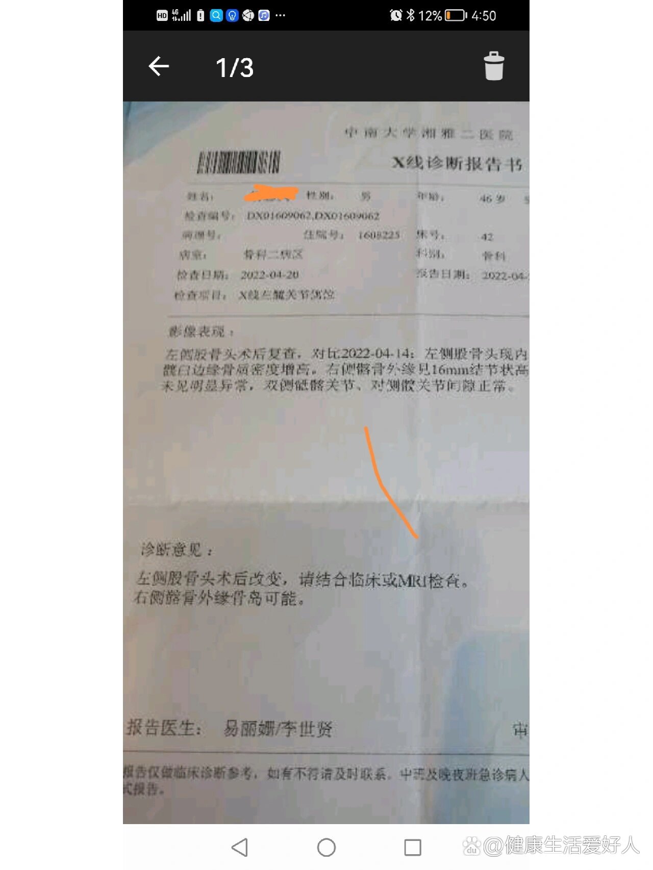 再发一个股骨头坏死病例