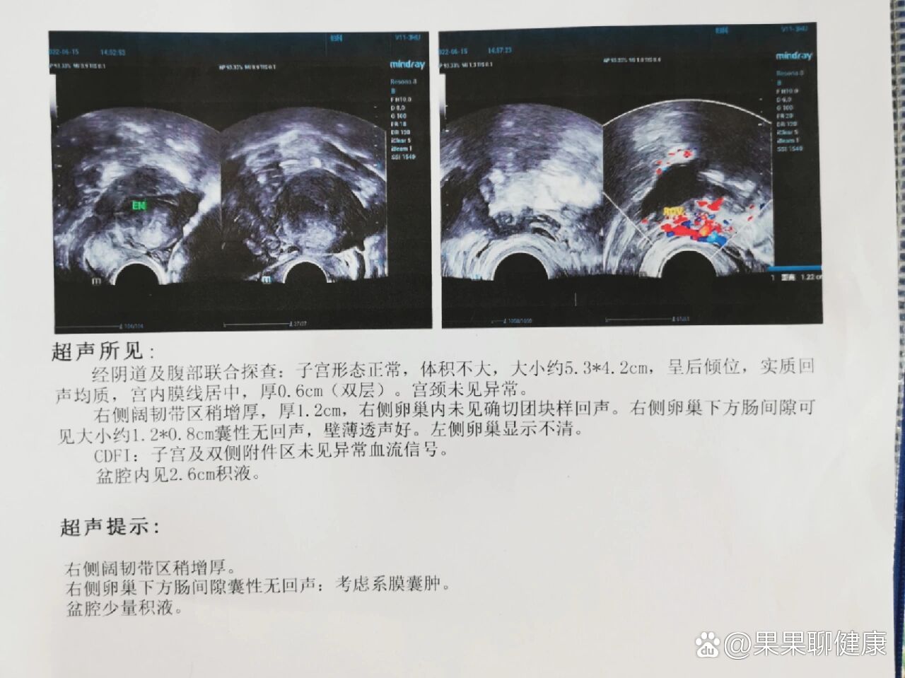 系膜囊肿,是个啥东东