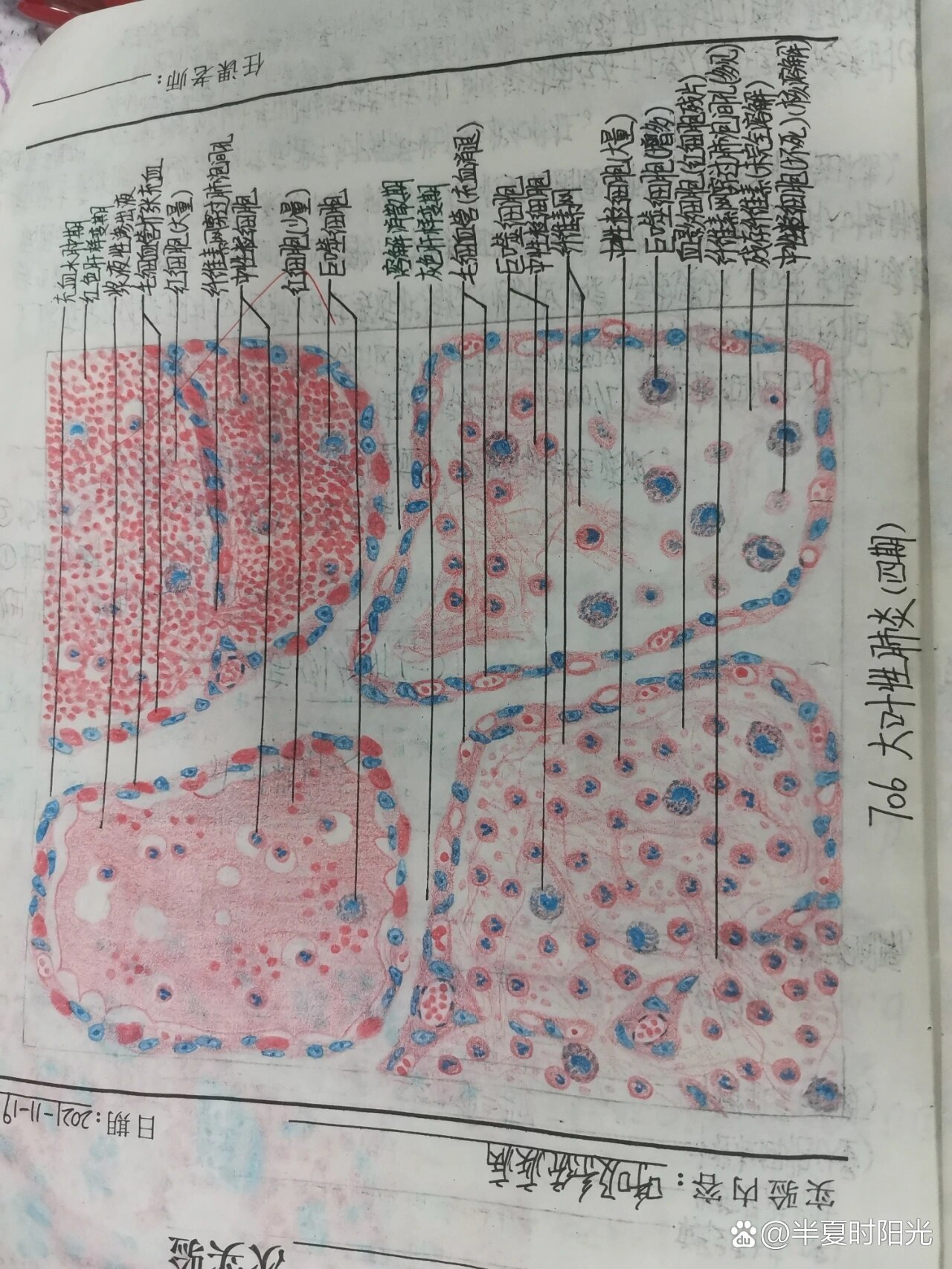 肺水肿红蓝铅笔图片