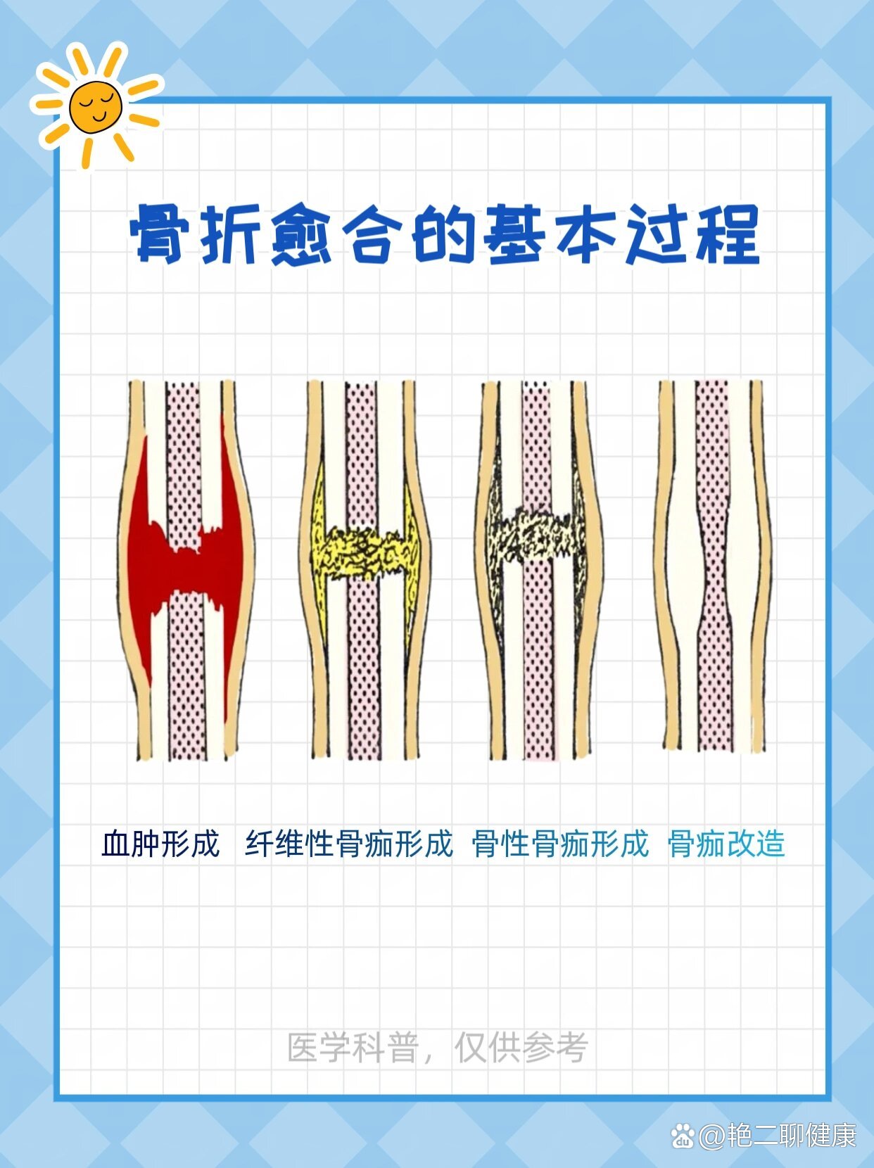 骨头愈合过程示意图图片