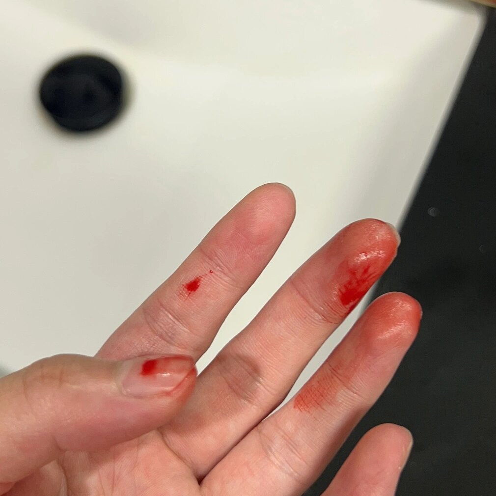 孕期鼻子喉咙出血