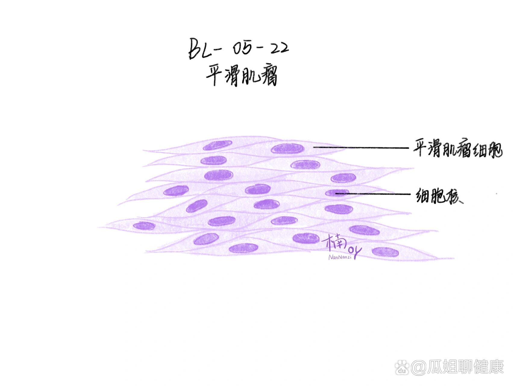 乳腺纤维腺瘤病理绘图图片