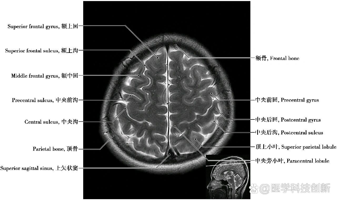 头部磁共振解剖(轴位)