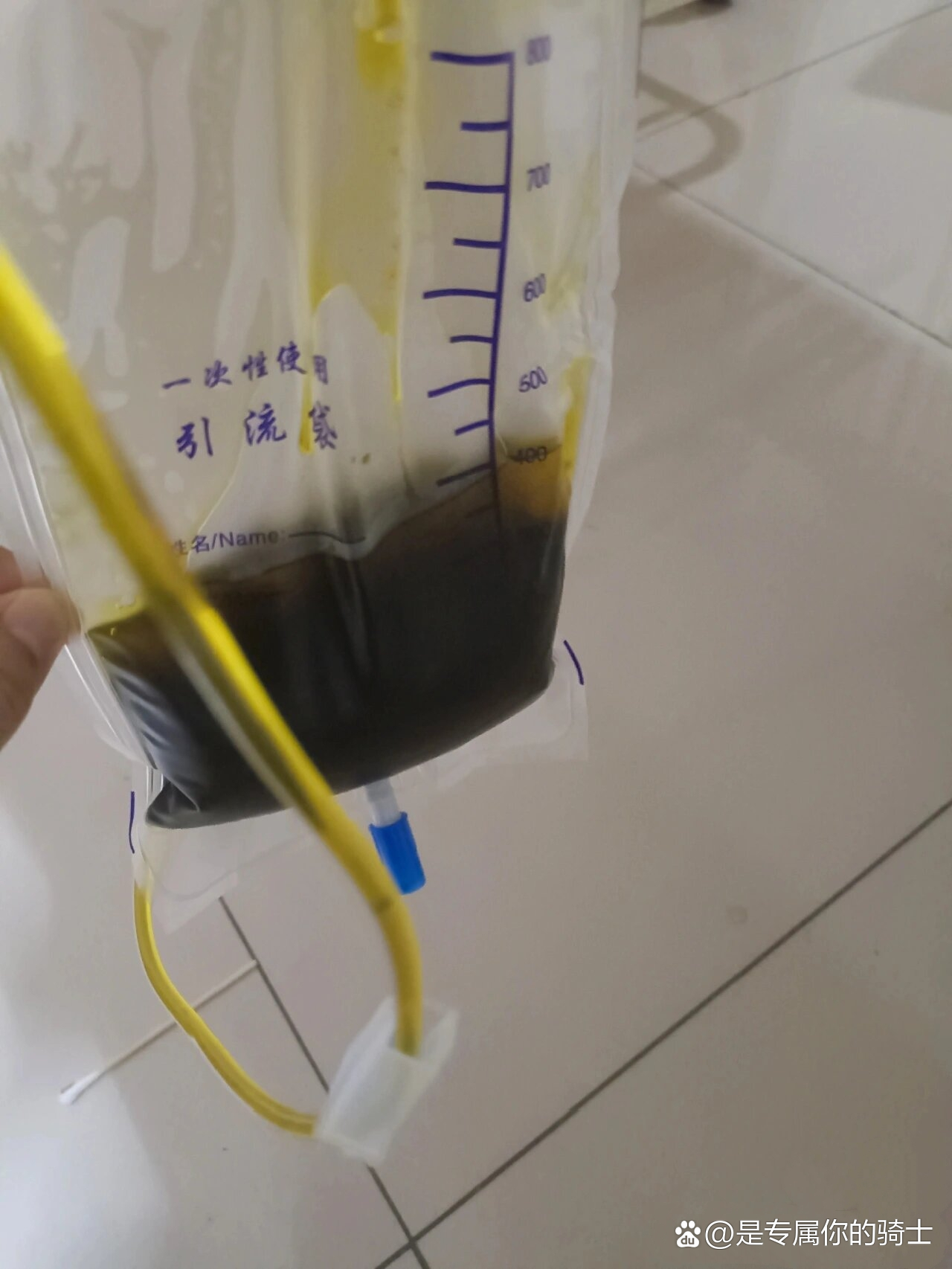 胆管堵死了支架做不了只有这个办法了 /p>