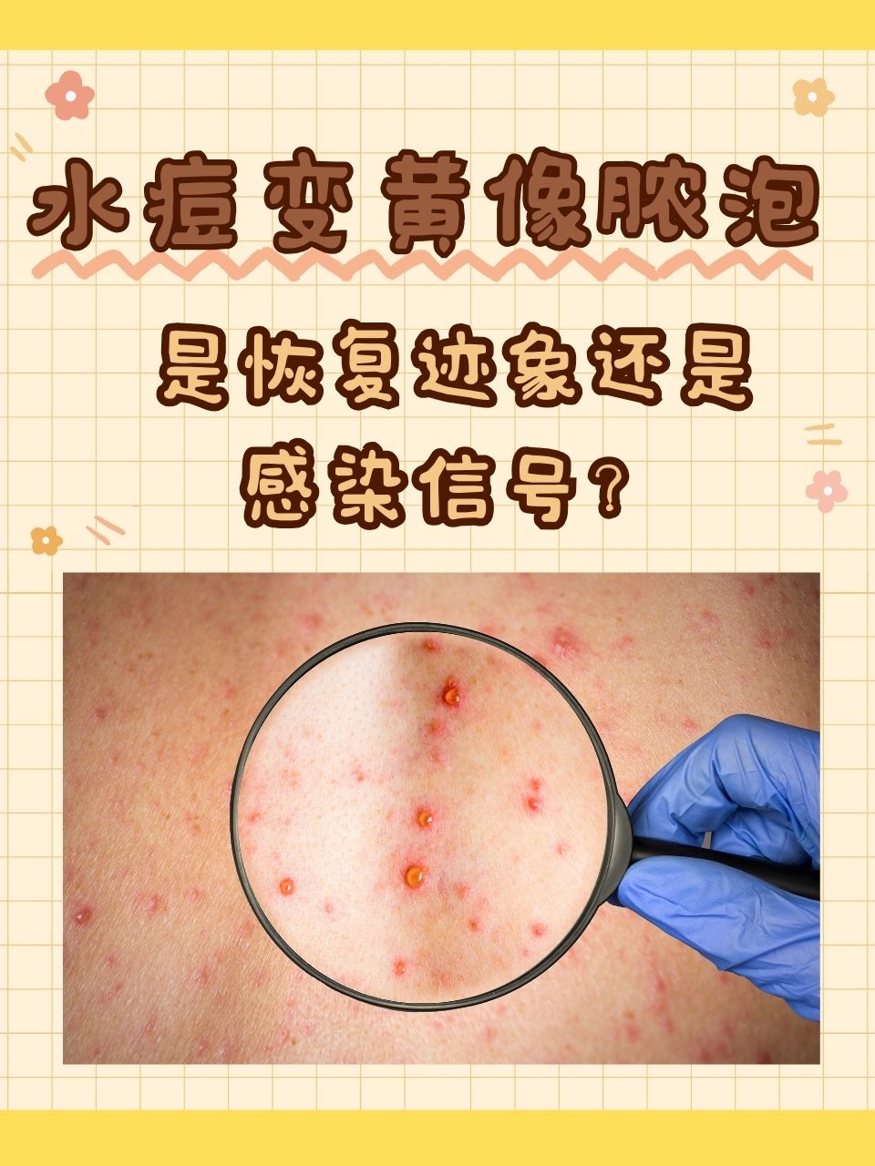 水痘变黄像脓泡:是恢复迹象还是感染信号?