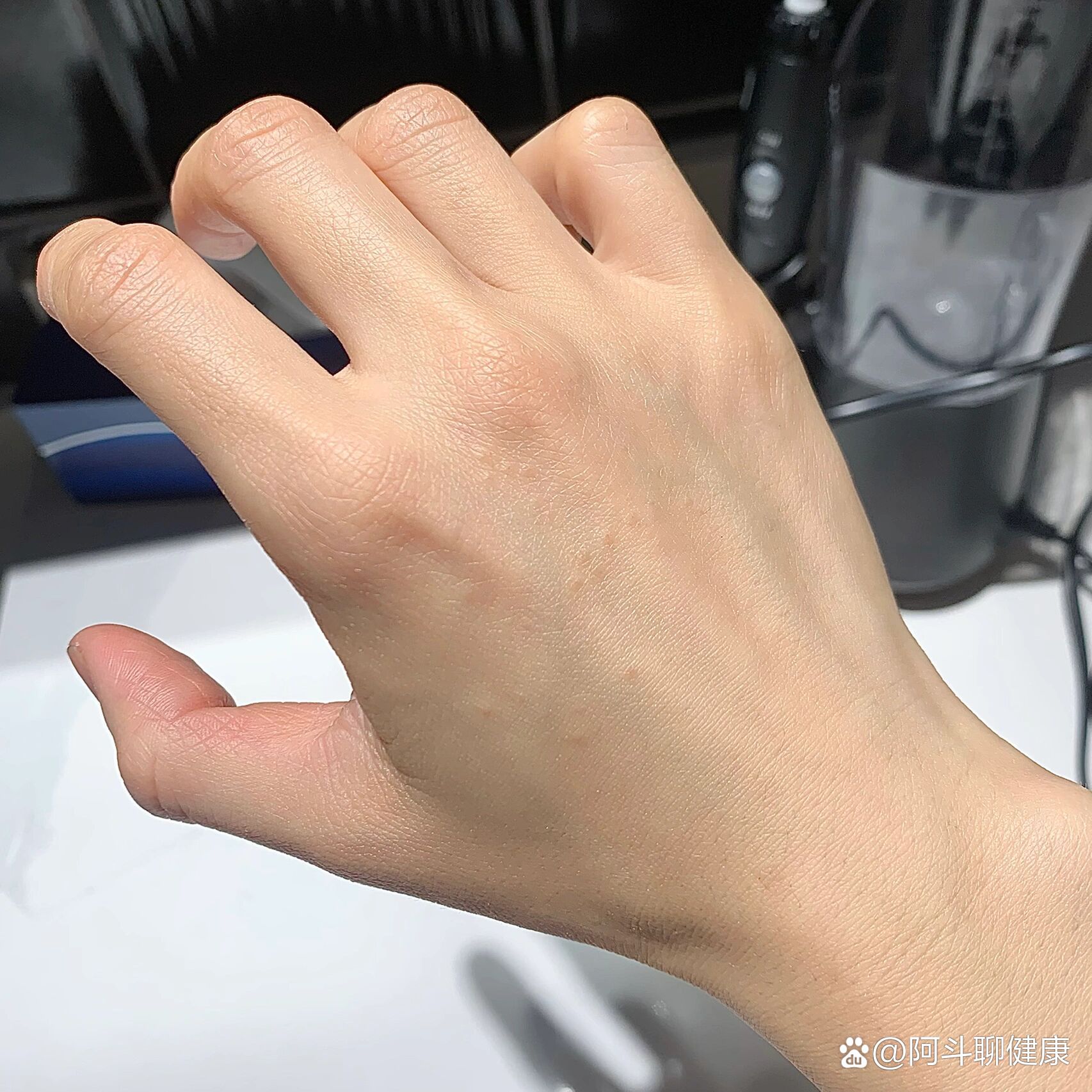 手背长了些不痛不痒的颗粒