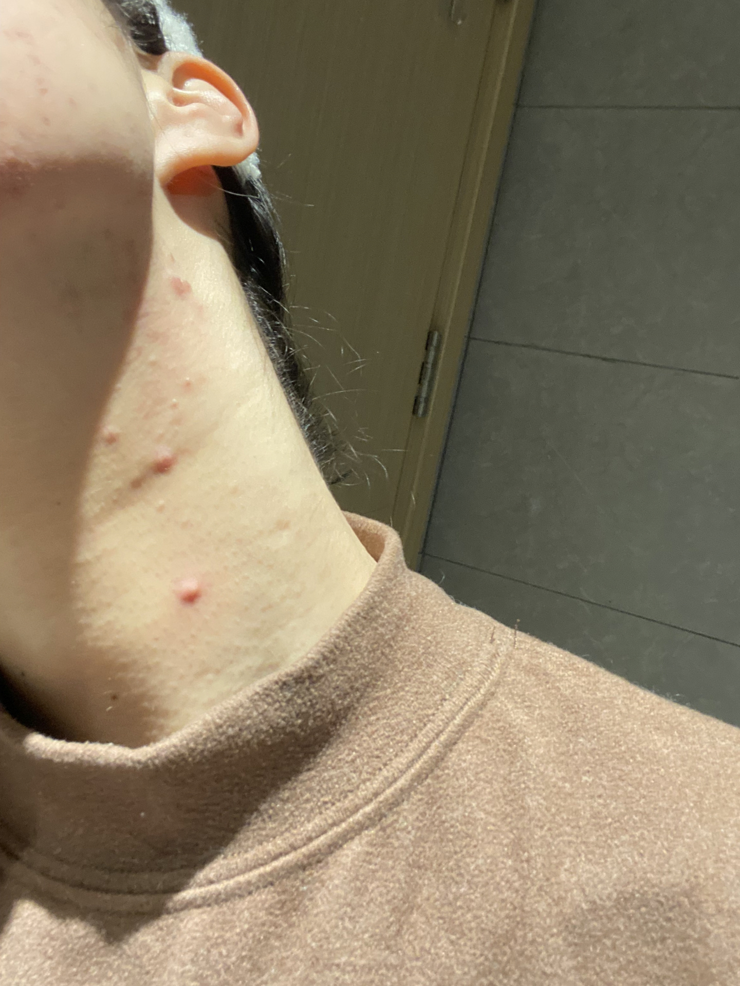 脖子长这种红疙瘩痘是为啥?