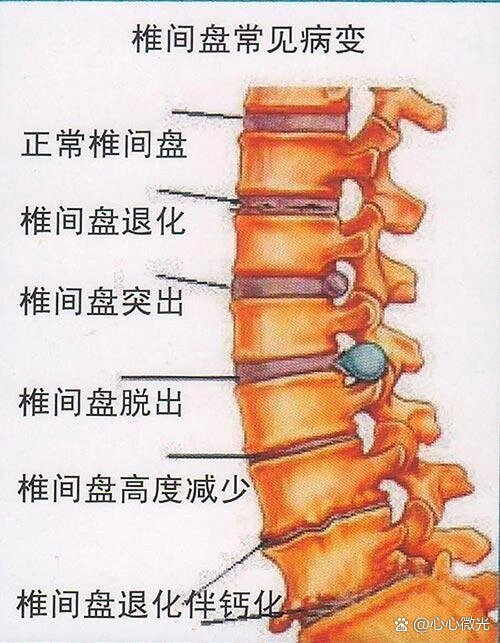 腰椎间盘位置结构图图片