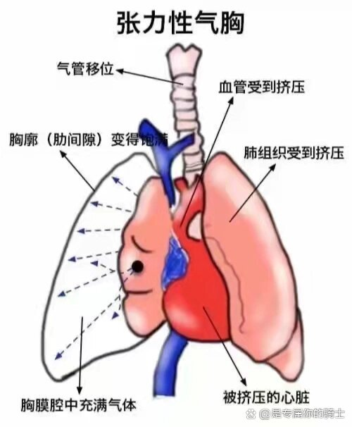 开放性气胸示意图图片