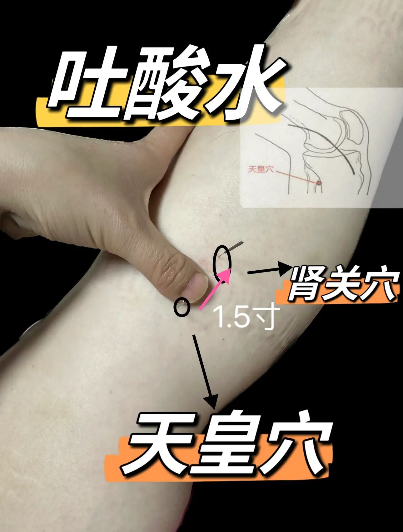 天皇穴准确位置图和作用