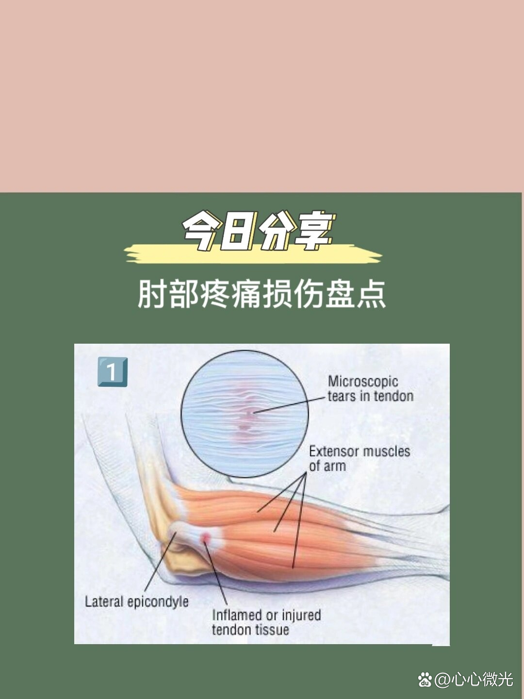 前臂疼痛是什么原因图片