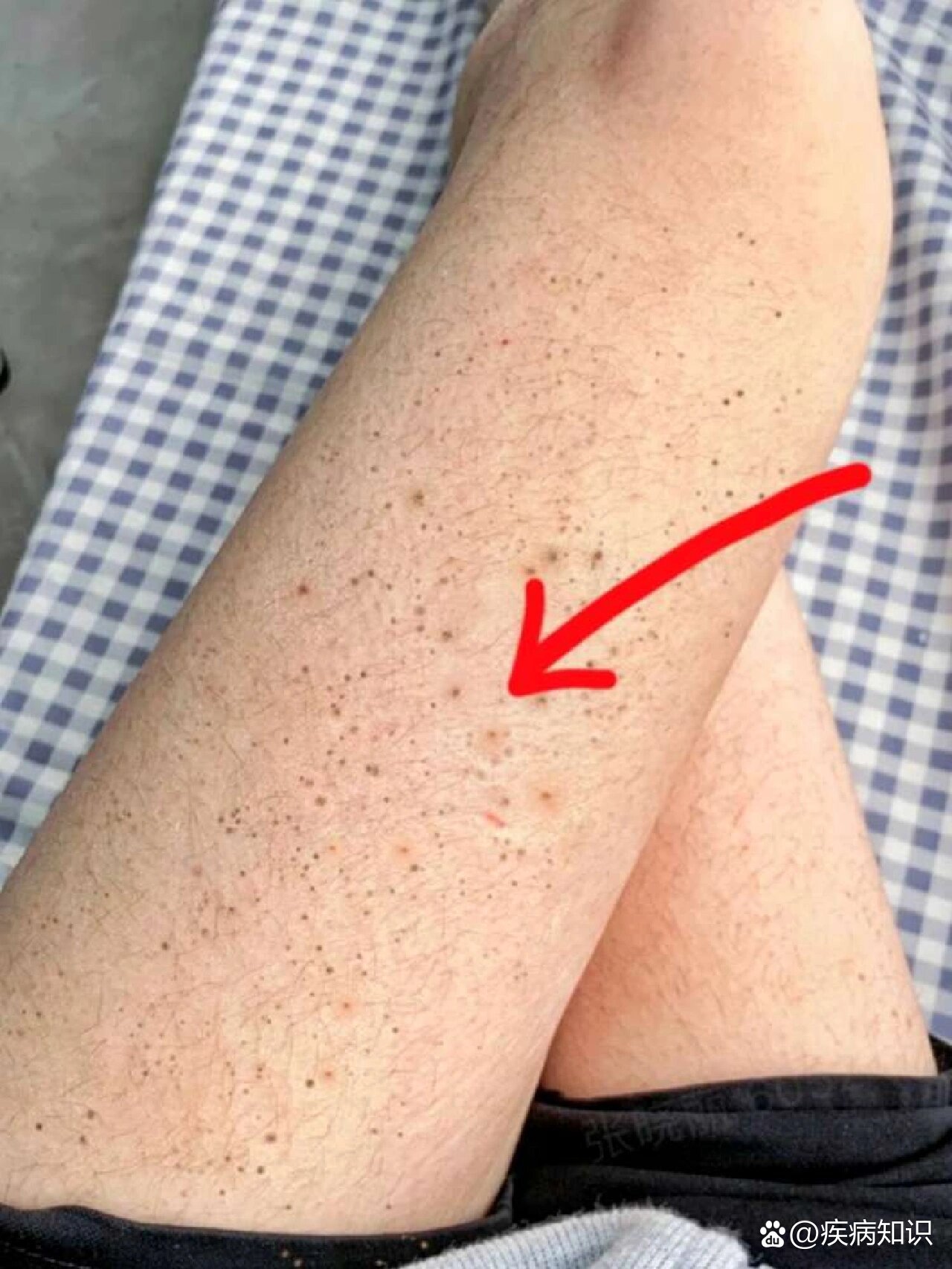 高危后才知道hpv转霉菌性阴道炎真的有征兆!