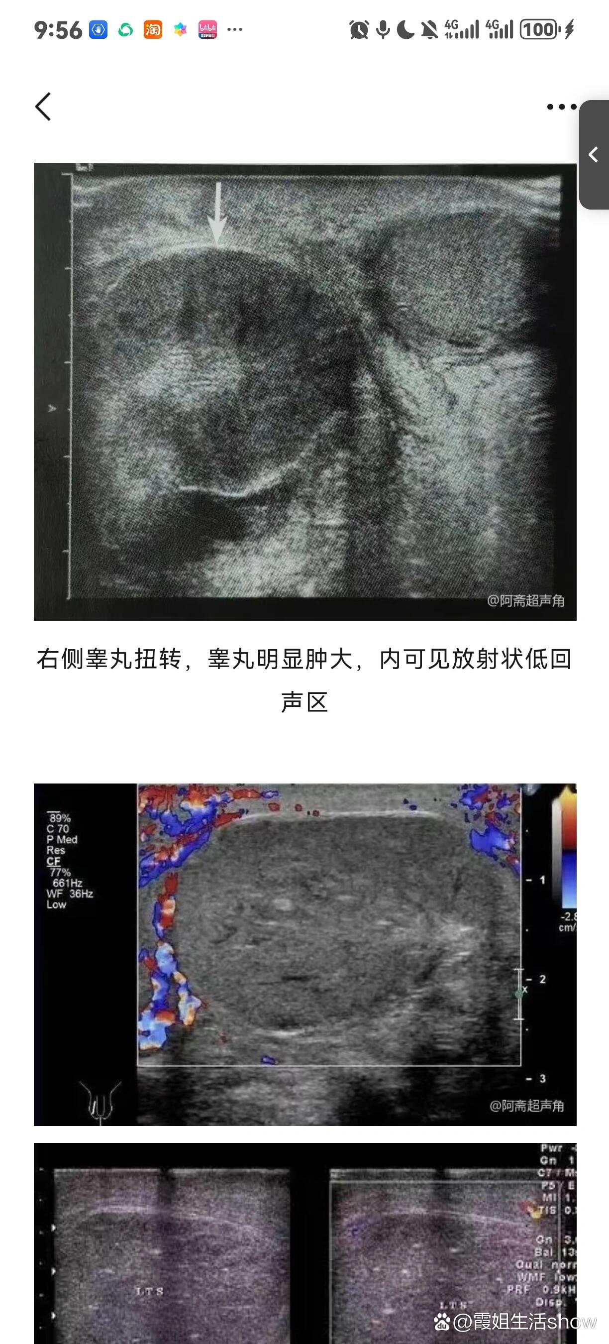 超声笔记--睾丸扭转超声表现