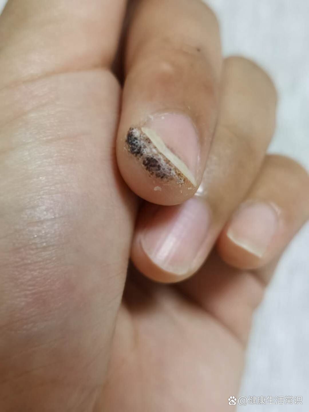 只是感染位置为甲周或甲下,称为甲周疣或甲下疣,可使指甲甲床破坏