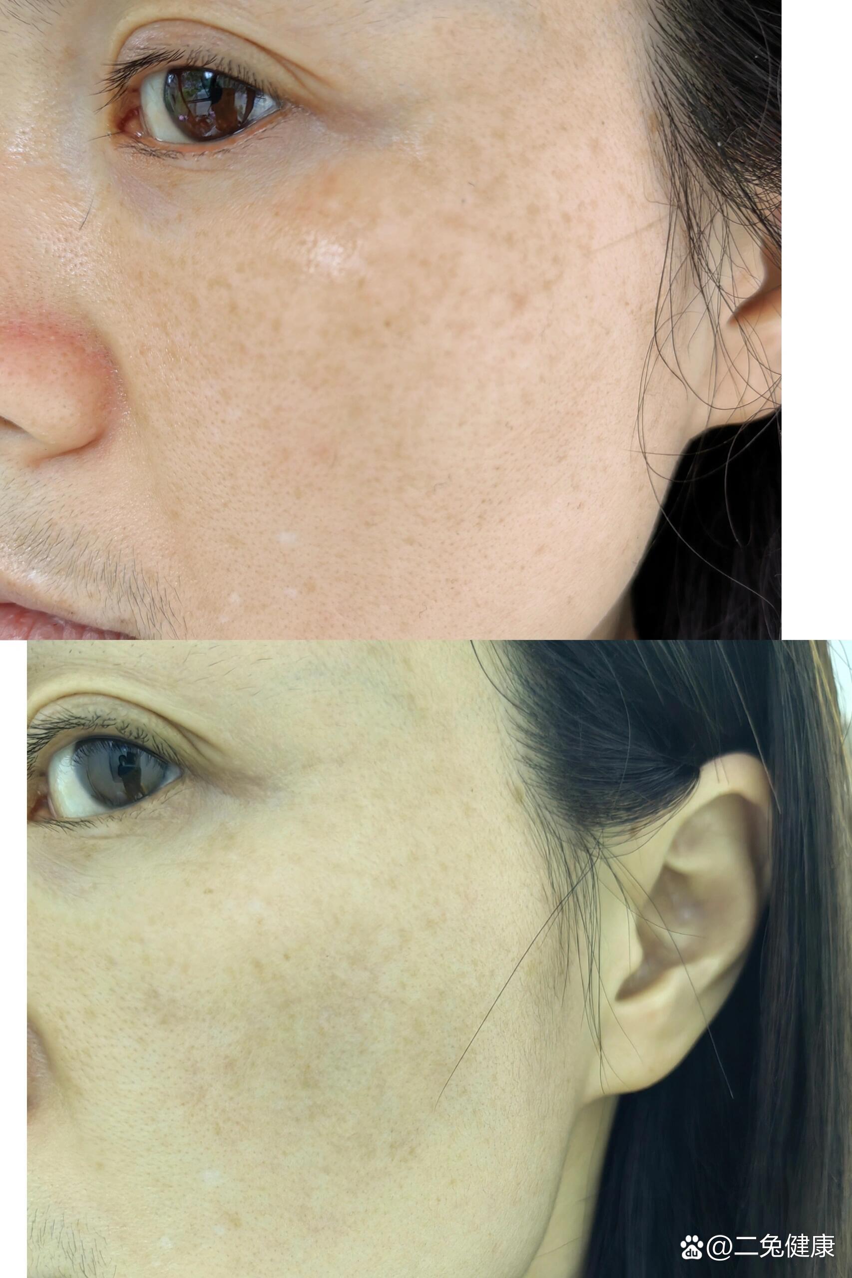 点刺放血祛斑效果,对比