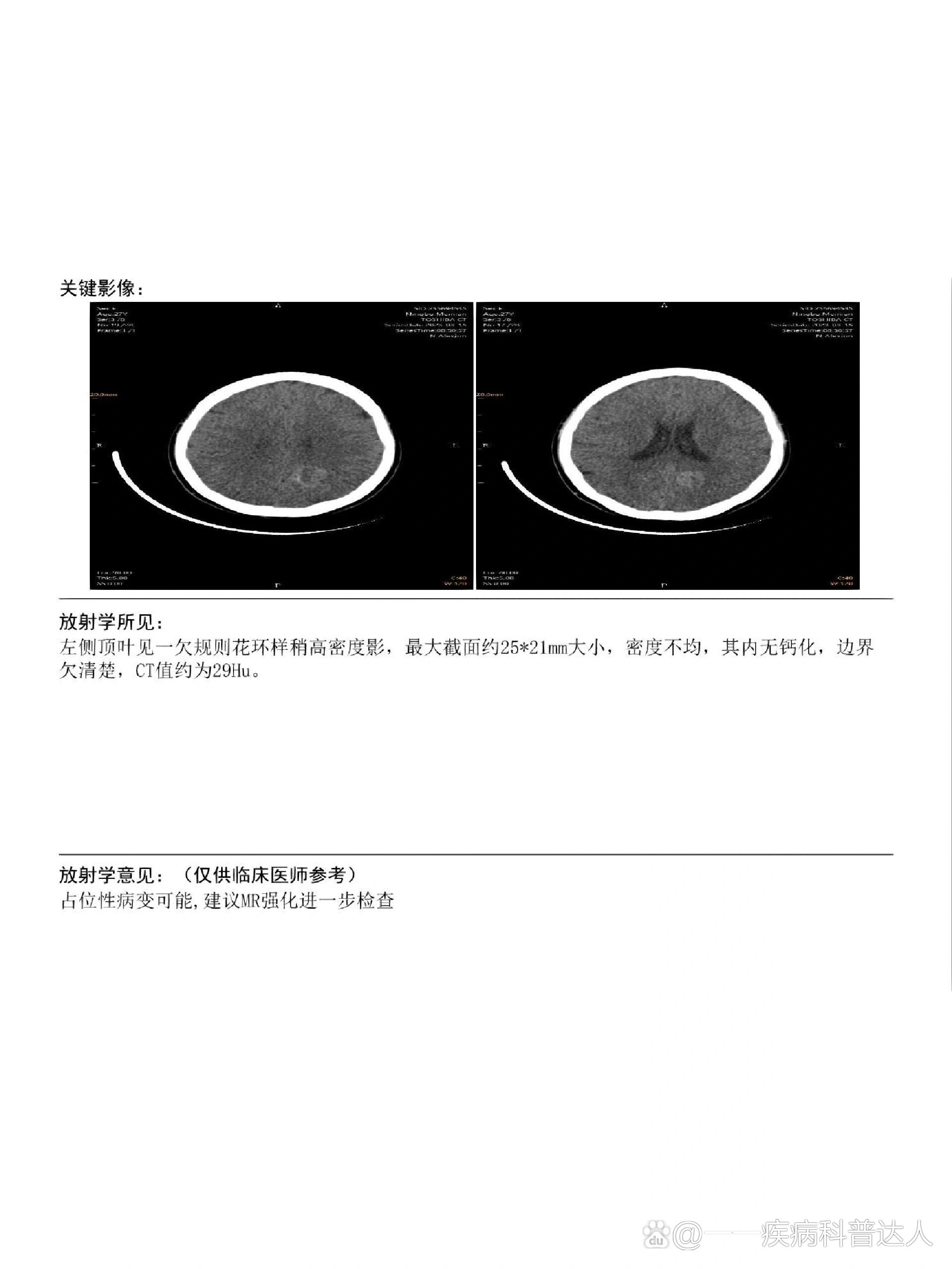 头皮血肿ct报告模板图片