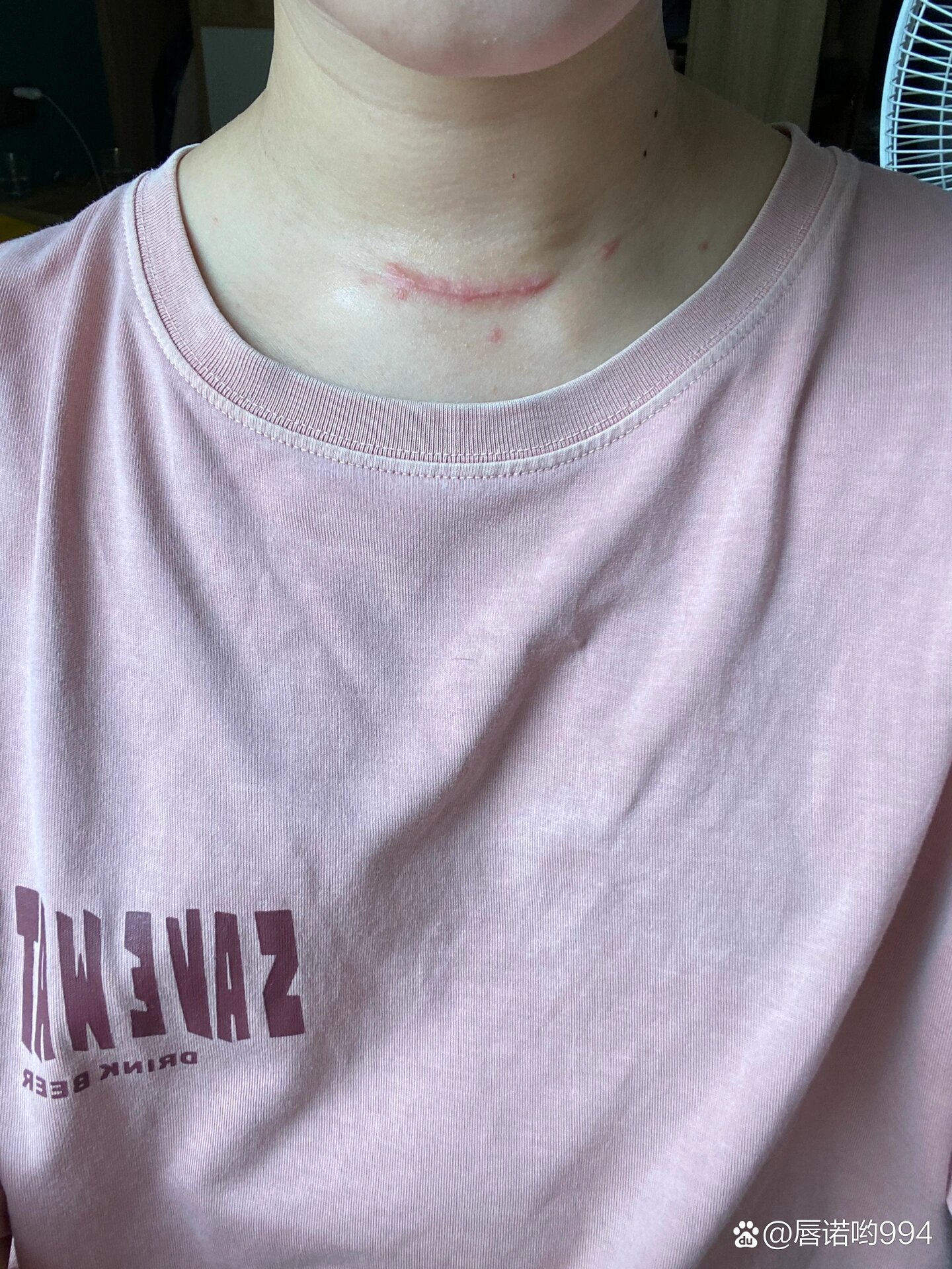 的地方经常疼,有时候会痒,有那种撕裂感,每天早上起床脖子那里很僵硬