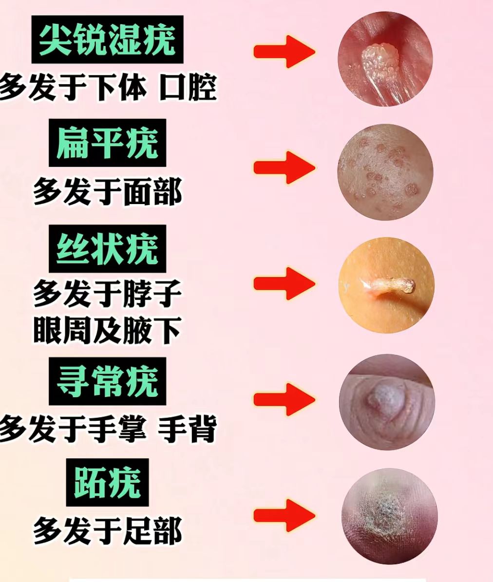 感染hpv后身体长出的5种疣分别是啥样子?
