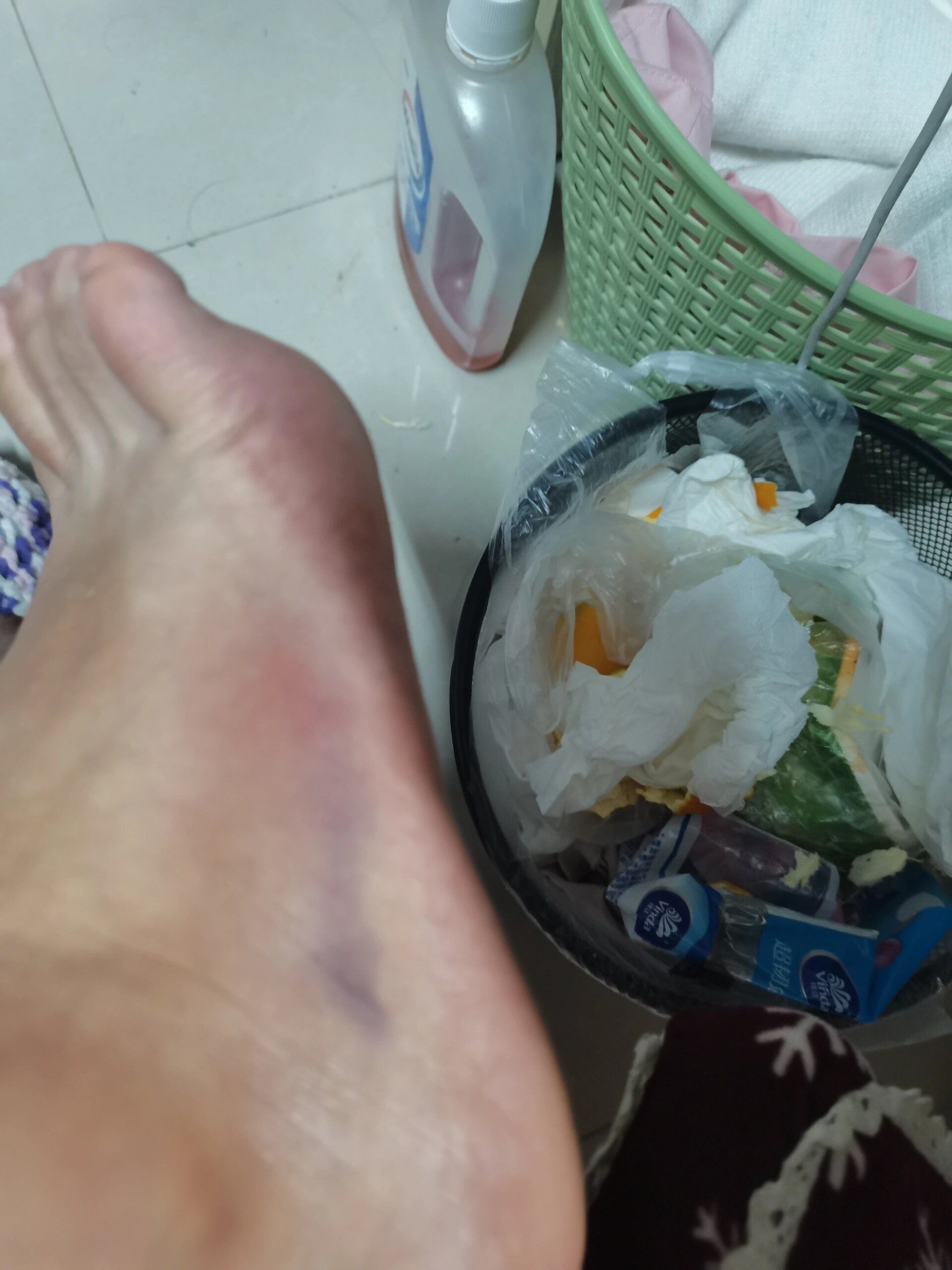 二天疼,脚背肿了一点点,后面就还好,只是走路的时候脚踝会有一点不适