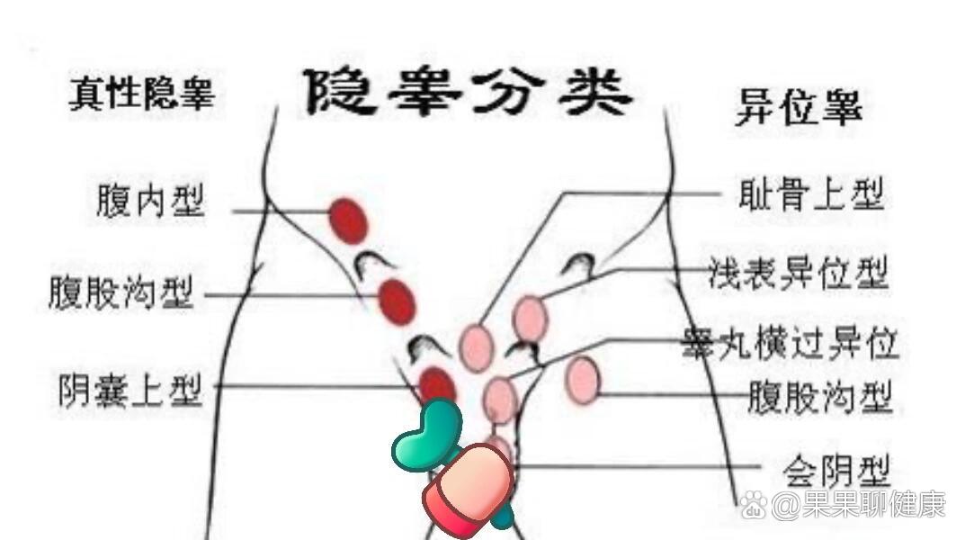 尿道下裂隐睾图片