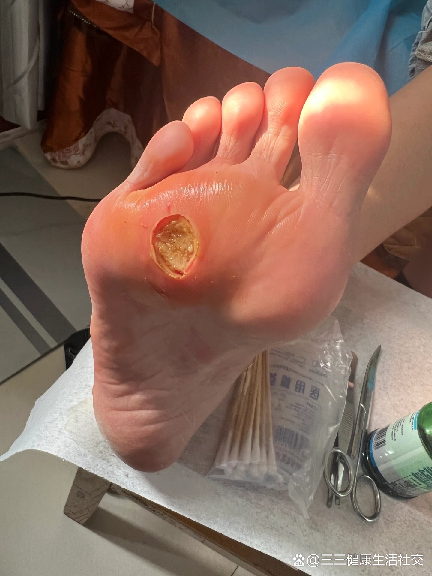 刺猴|根治用了46615种方法,给大家传授经验