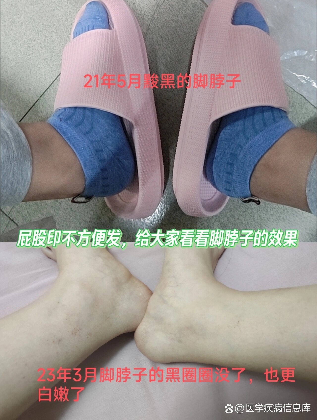 【学生党】【久坐族】的屁股黑印有救啦