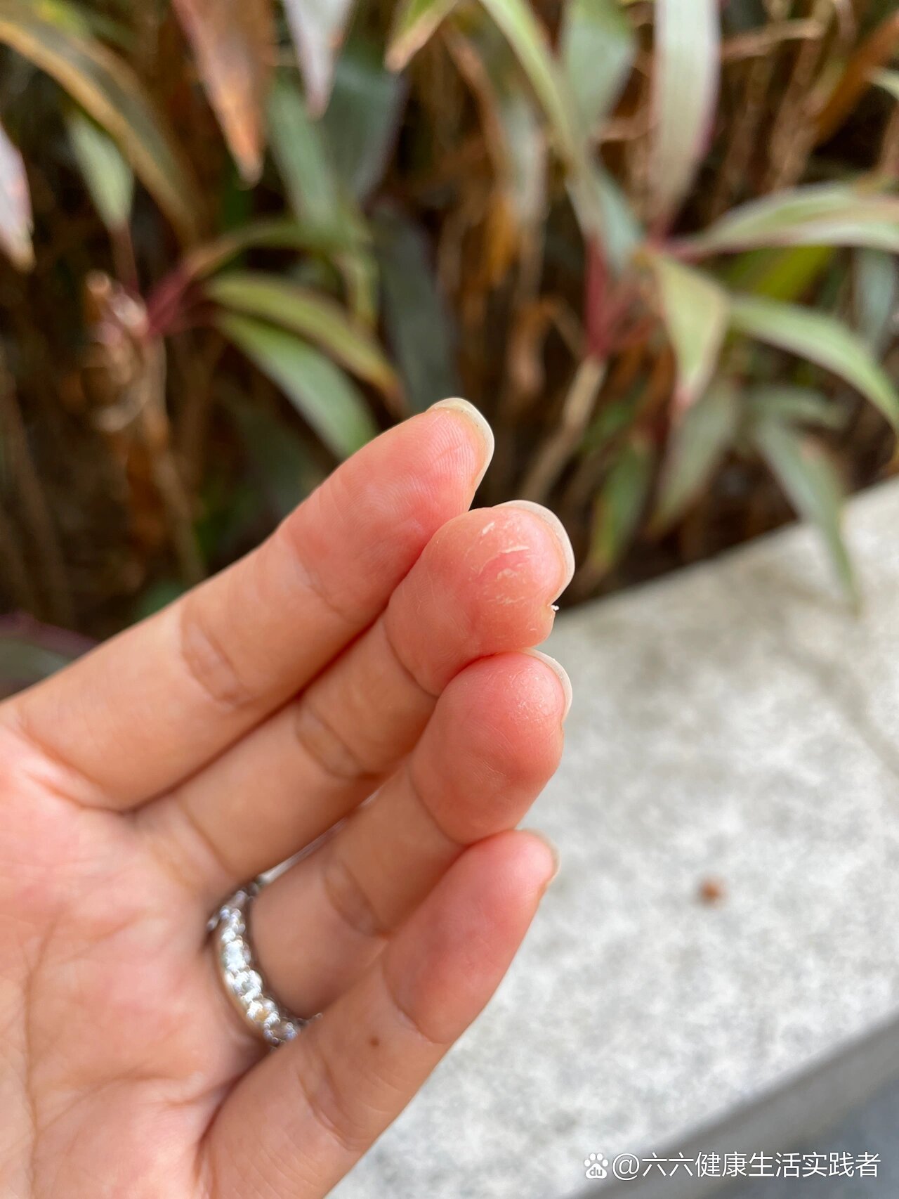 天气一冷,手指尖就起皮开裂!