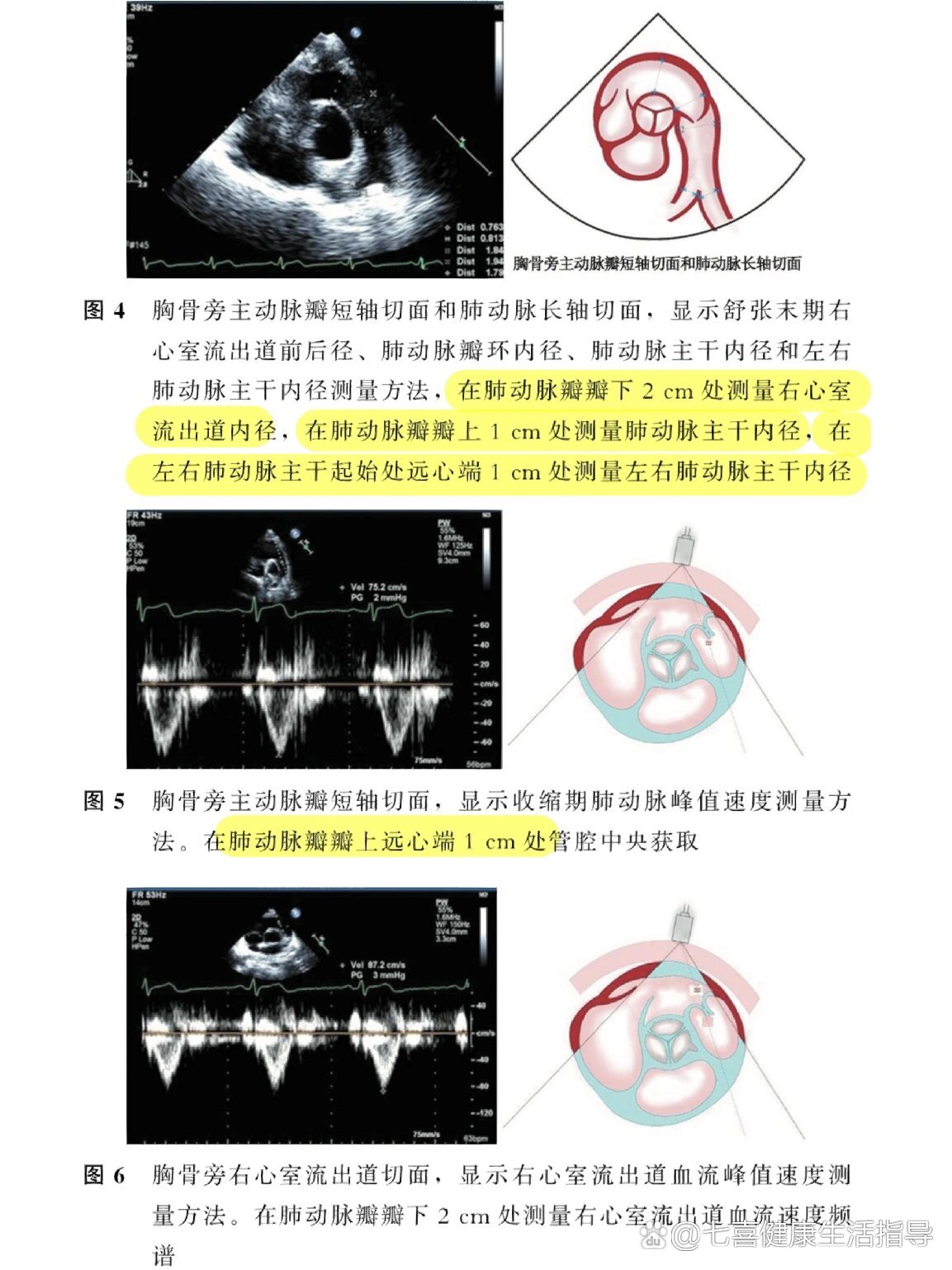 心脏超声5个标准切面图片