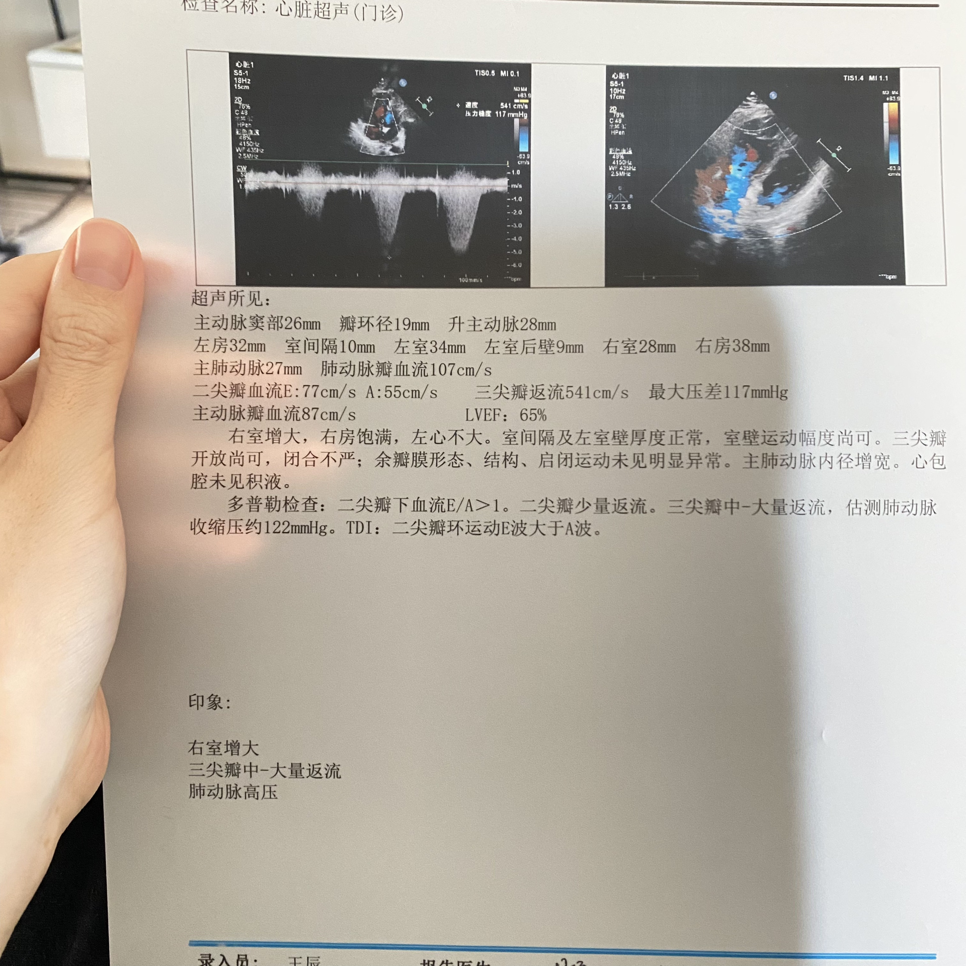 右心室调节束超声图像图片