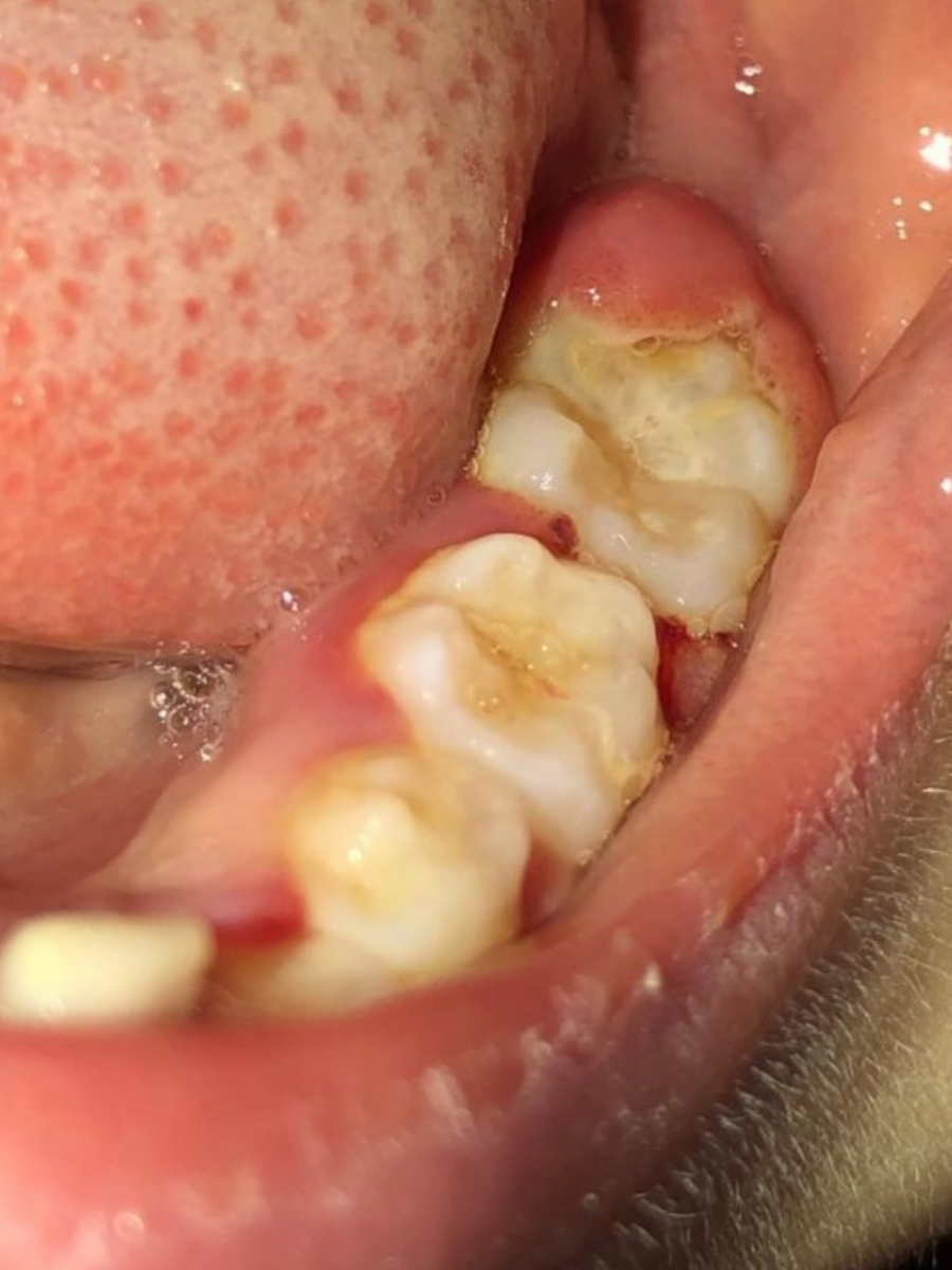 6岁孩子患疱疹性龈口炎——牙龈肿痛并非全是上火
