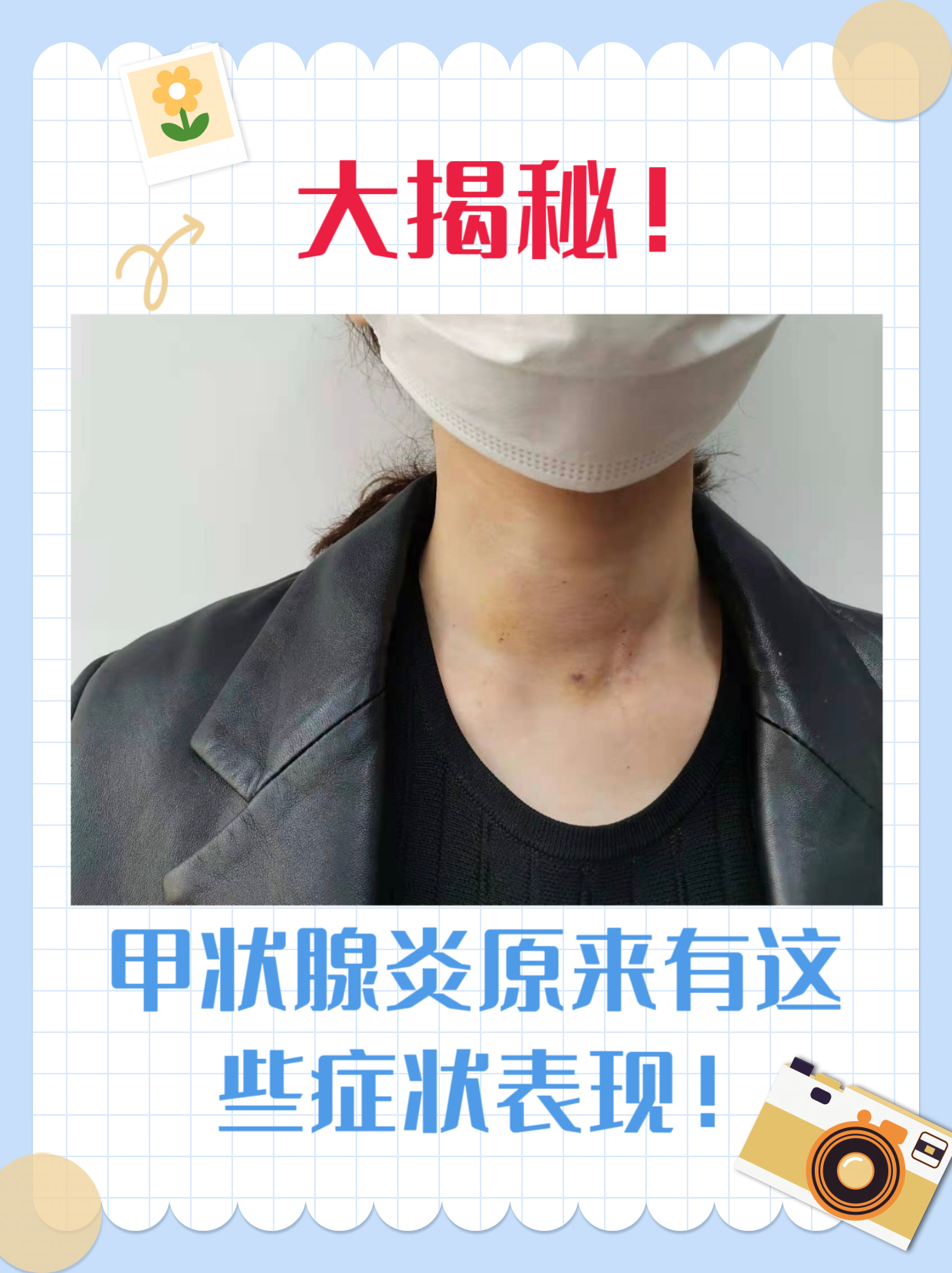 大揭秘!甲状腺炎原来有这些症状表现!
