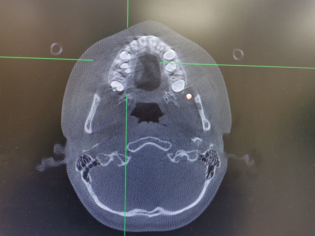 男孩患组合性牙瘤,孩子新牙无法萌出需警惕!