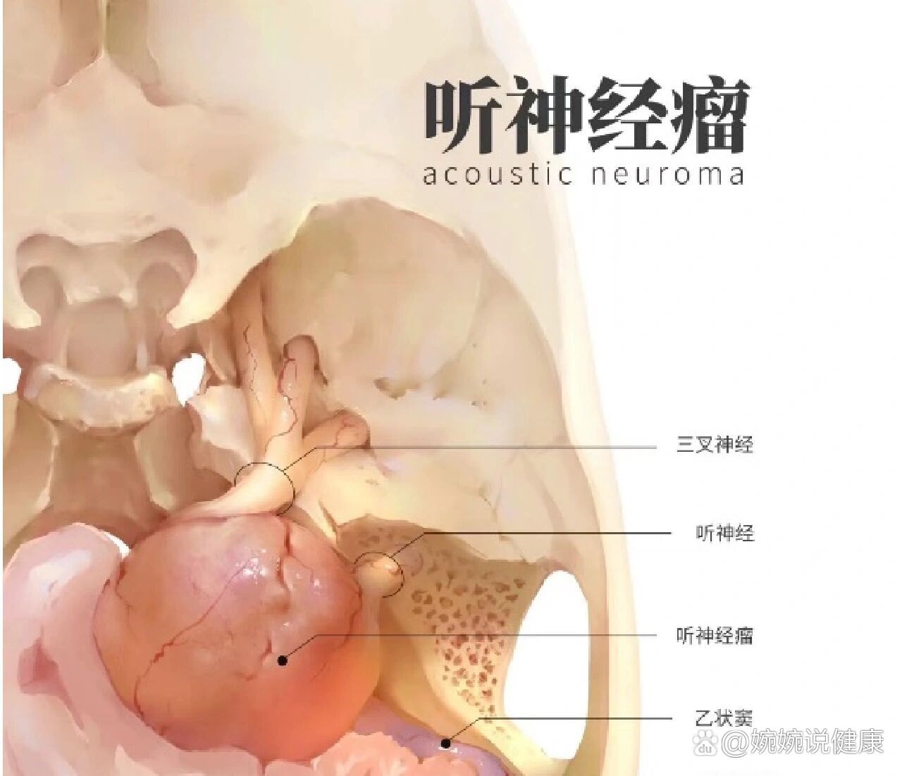 听神经瘤这7个要点你知道吗?