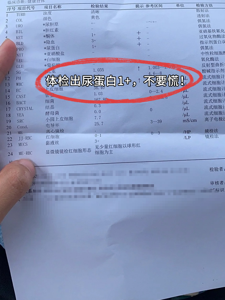 尿蛋白阳性图片